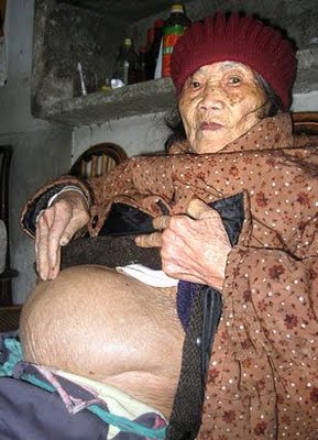In 2009, a 92-year-old Chinese Woman Named Huang Yijun Delivered a Child That She Had Been Carrying for Over Half a Century. 2 theheraldng