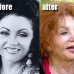 Celebrity Before And After Plastic Surgery