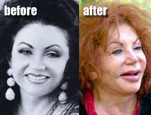 Celebrity Before And After Plastic Surgery